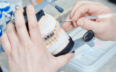 Come sbiancare i denti della protesi