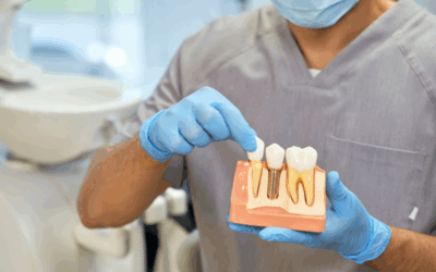 Come si mettono gli impianti dentali