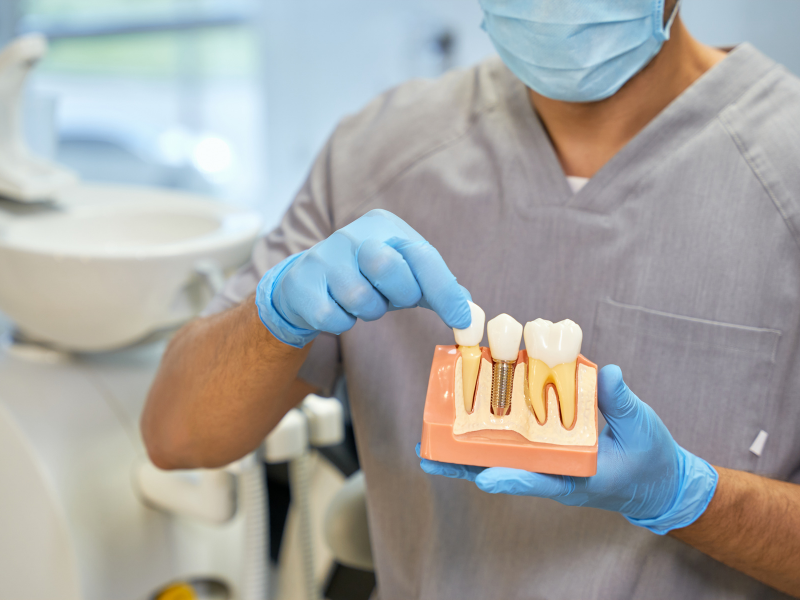 Come si mettono gli impianti dentali