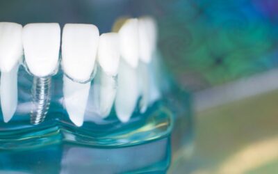 Cosa sono i MUA in implantologia
