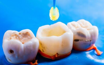 Otturazione dente: quanto dura?
