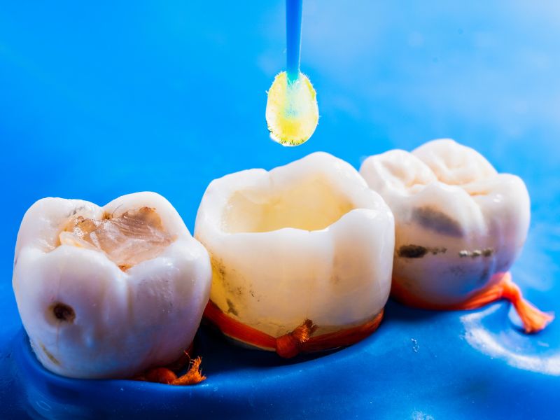 quanto dura un'otturazione dentale