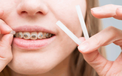 Cera per apparecchio denti: come si usa