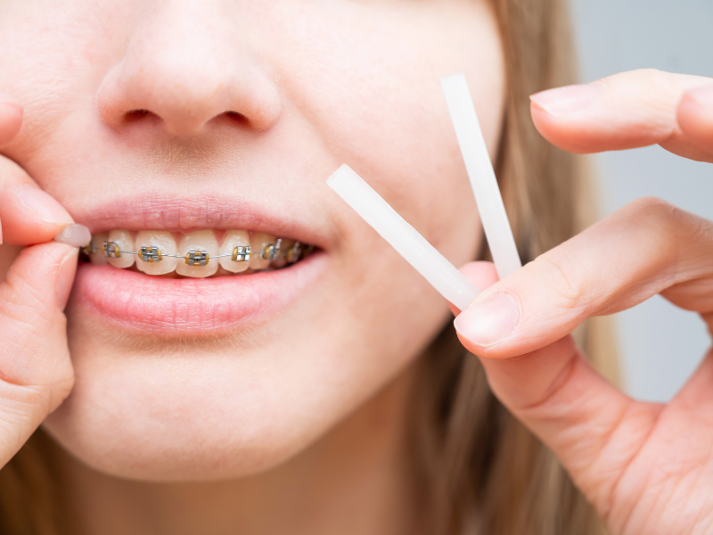 Cera per apparecchio denti come si usa