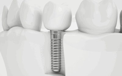 Come pulire gli impianti dentali