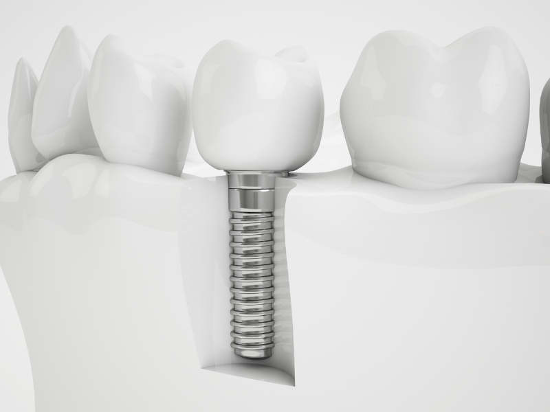 Come pulire gli impianti dentali