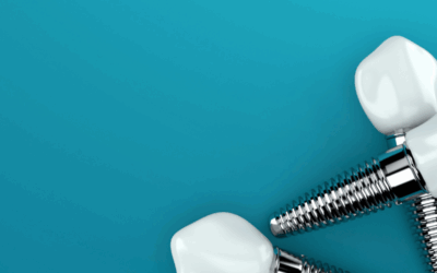 Quanti tipi di impianti dentali esistono?