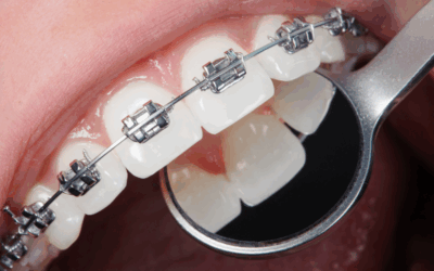Dolore ai denti dopo l’apparecchio fisso: quanto dura e cosa aspettarsi