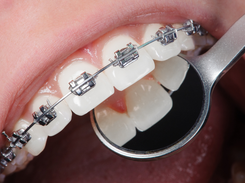 Dolore ai denti dopo l'apparecchio fisso