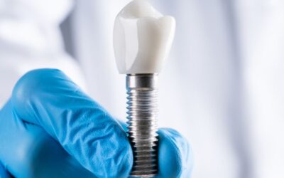 Impianti dentali: quali sono i segnali che potrebbero indicare un rigetto?