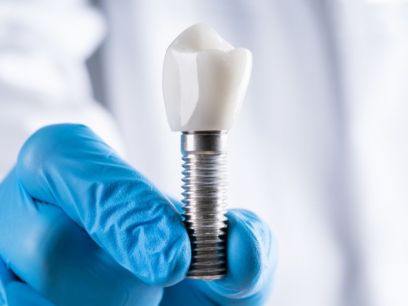 Impianti dentali: quali sono i segnali che potrebbero indicare un rigetto?
