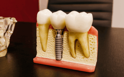 Cosa succede se si rompe un impianto dentale? Tempi e soluzioni