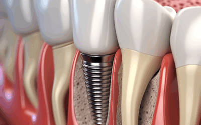 Dopo gli impianti dentali cosa fare: consigli e accorgimenti per una guarigione ottimale
