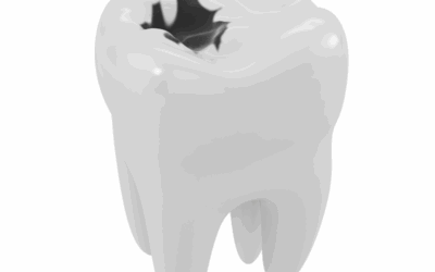 È possibile eliminare la carie senza andare dal dentista?
