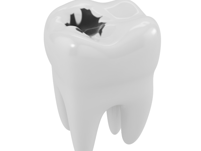 e-possibile-eliminare-la-carie-dai-denti-senza-andare-dal-dentista