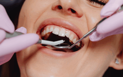 Come prendersi cura delle gengive dopo un impianto dentale