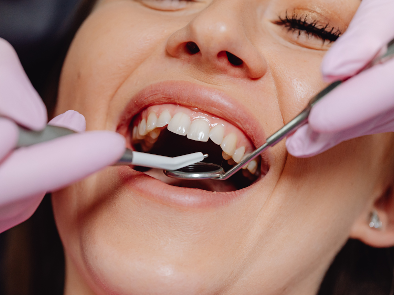 Come prendersi cura delle gengive dopo un impianto dentale
