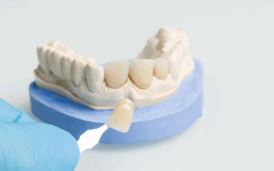 Faccette dentali: cosa sono, quando si usano e perché sceglierle