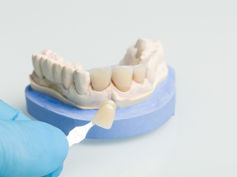 Faccette dentali cosa sono, quando si usano e perché sceglierle